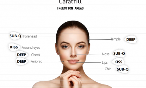 Lip fillers