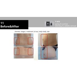 V-Sol lipolysis solution for face and body 10 ml *5 vial/ box S.Korea 